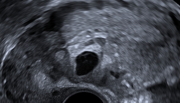 Caesarean scar pregnancy