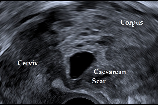 Cesarean scar pregnancy