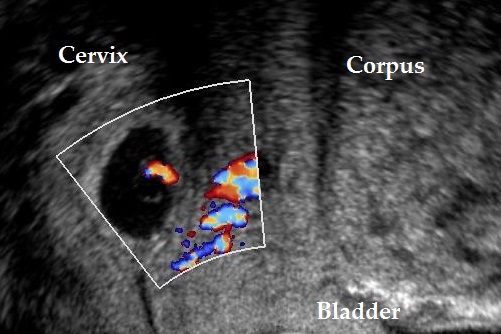 Cervical pregnancy