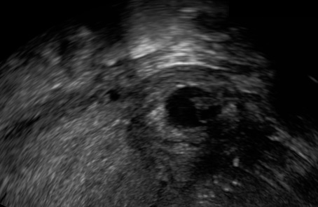 Interstitial pregnancy