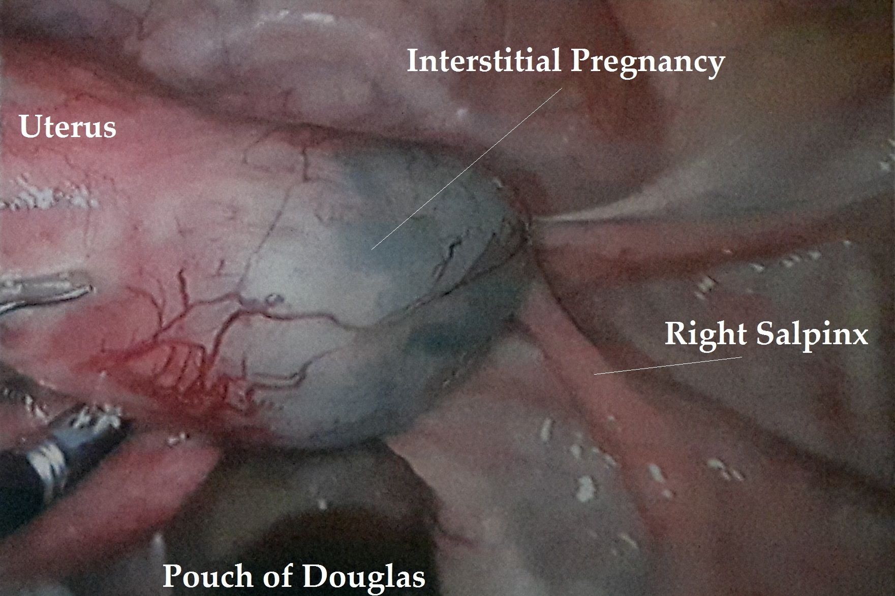Interstitial Pregnancy Operation