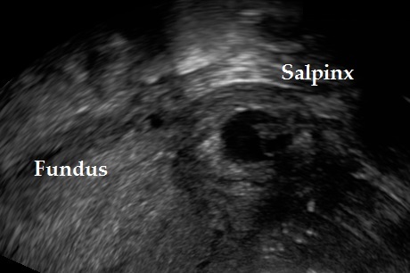 Interstitial Pregnancy