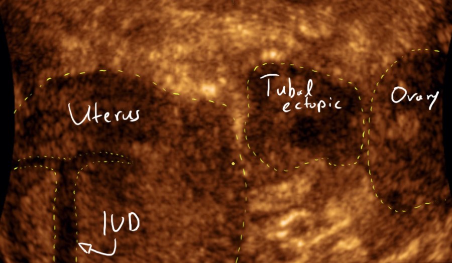 Masterclass – Ultrasound Study of the Tubal Ectopic Pregnancy