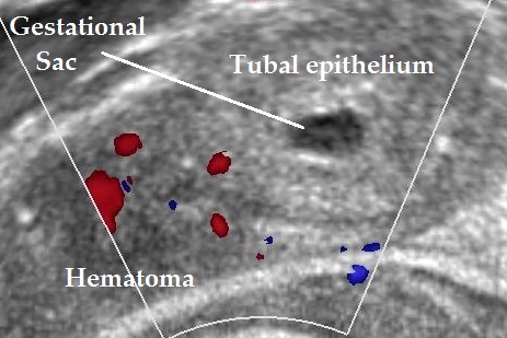 tubal ectopic pregnancy bagel sign