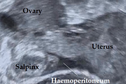 tubal ectopic pregnancy blob sign