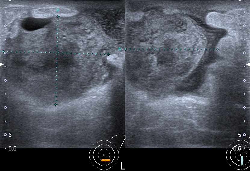 Infectious non-puerperal mastitis