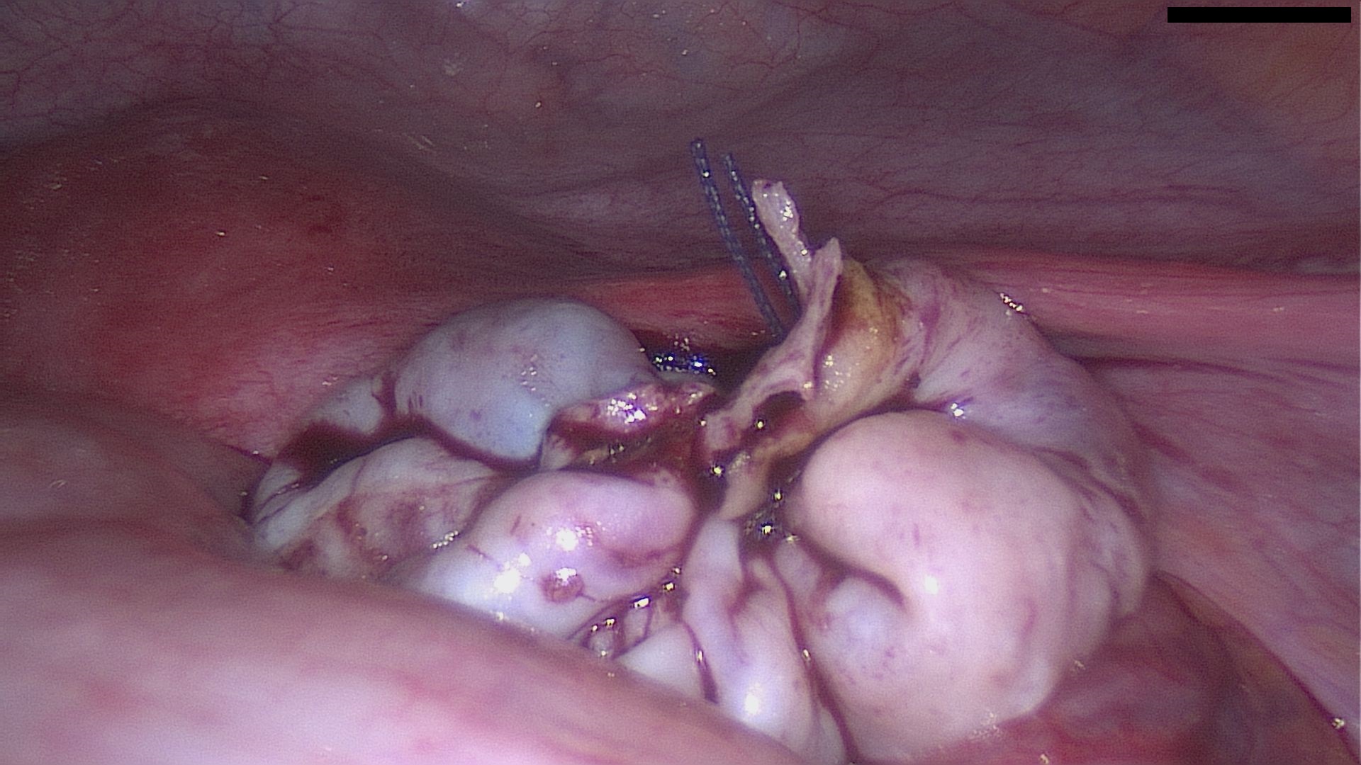 Struma ovarii organ sparing laparoscopy
