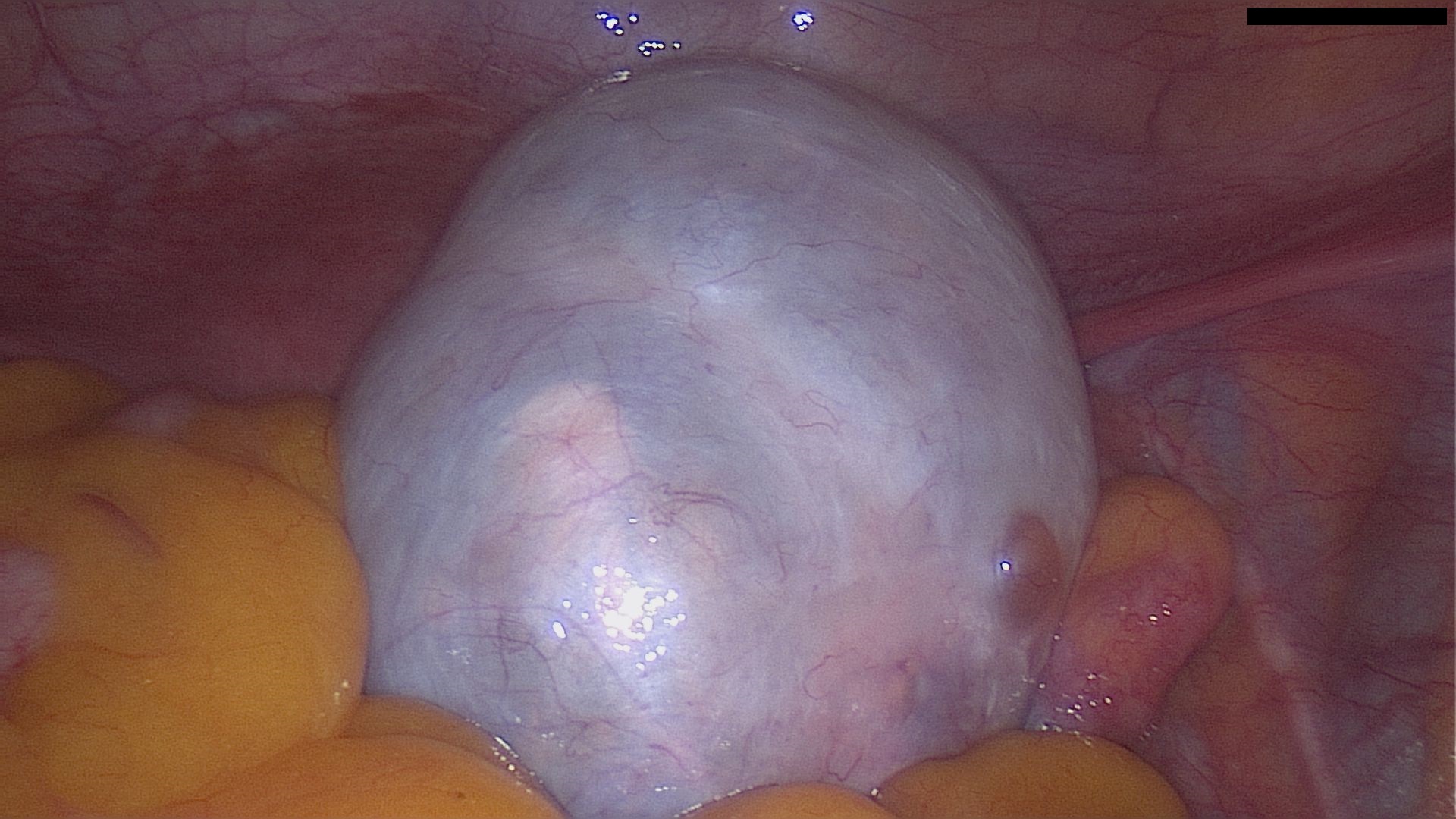 Struma ovarii laparoscopy