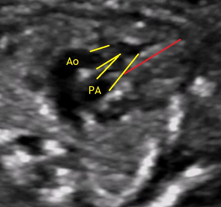 Double outlet right ventricle