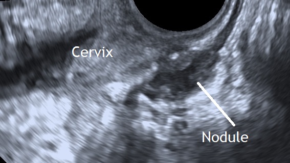Endometriosis of rectovaginal space Text
