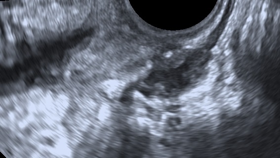 Deep infiltrating endometriosis