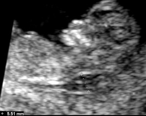 increased nuchal translucency