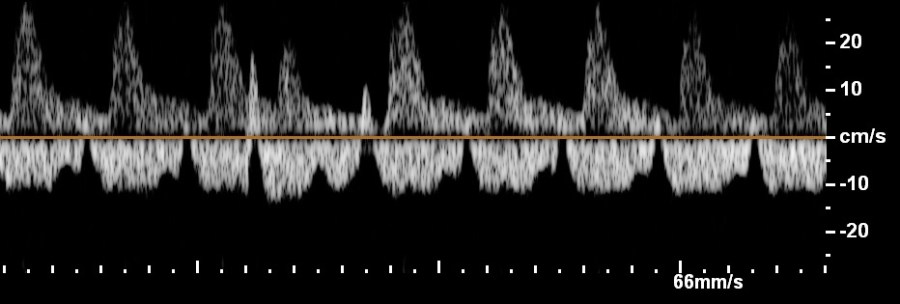 Fetal premature atrial contractions