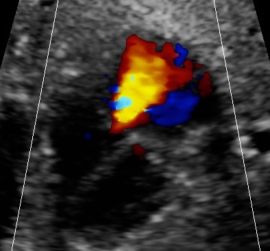 Fetal hyperthyroidism