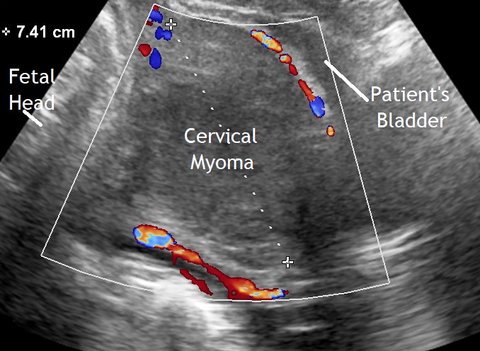 Uterine myomas and pregnancy