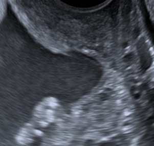 Cervical insufficiency ultrasound