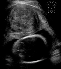 Uterine myoma in pregnancy 1