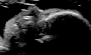 Absent fetal nasal bone