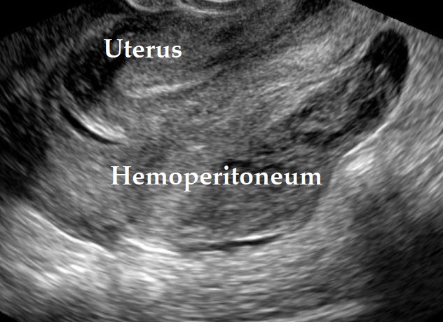 haemoperitoneum