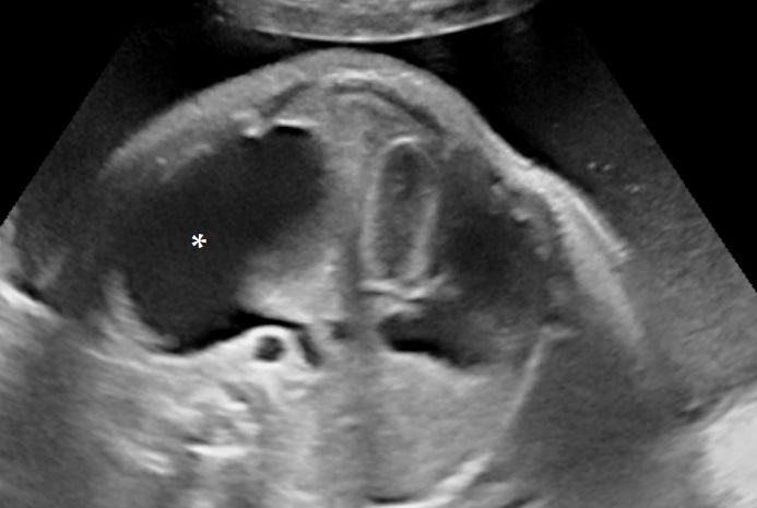 Hydrothorax and Polyhydramnios