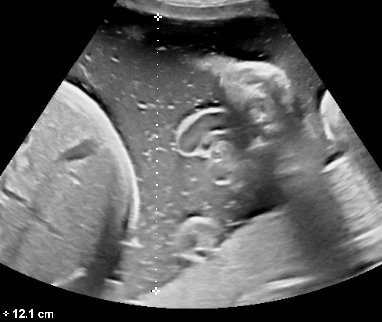 How to measure the amniotic fluid