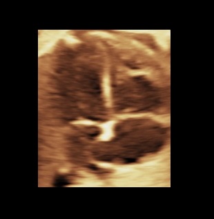 How to: the four chamber view