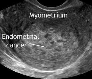 endometrial cancer