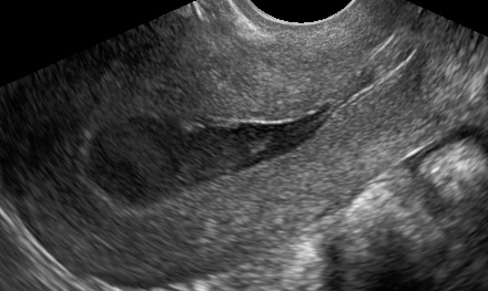 Hematometra after conization