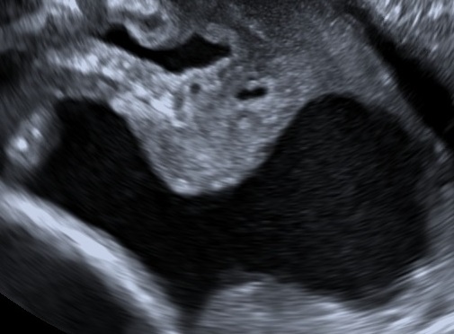 Hourglass membranes (prolapsed membranes)