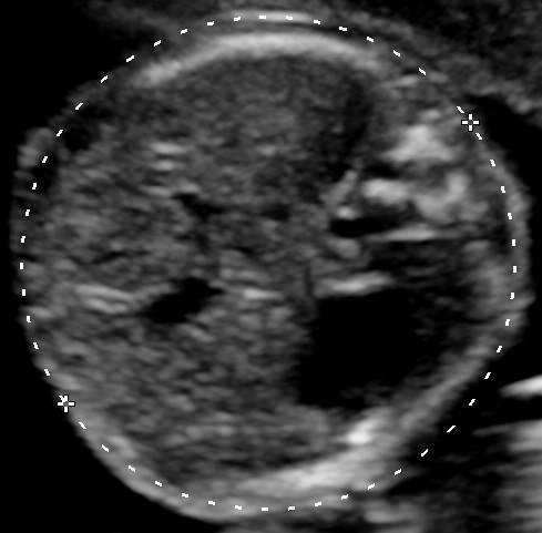 fetal abdomen ultrasound correct plane