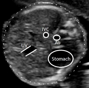 fetal abdomen ultrasound