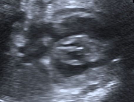 Fetal hypertrophic cardiomyopathy in maternal diabetes mellitus