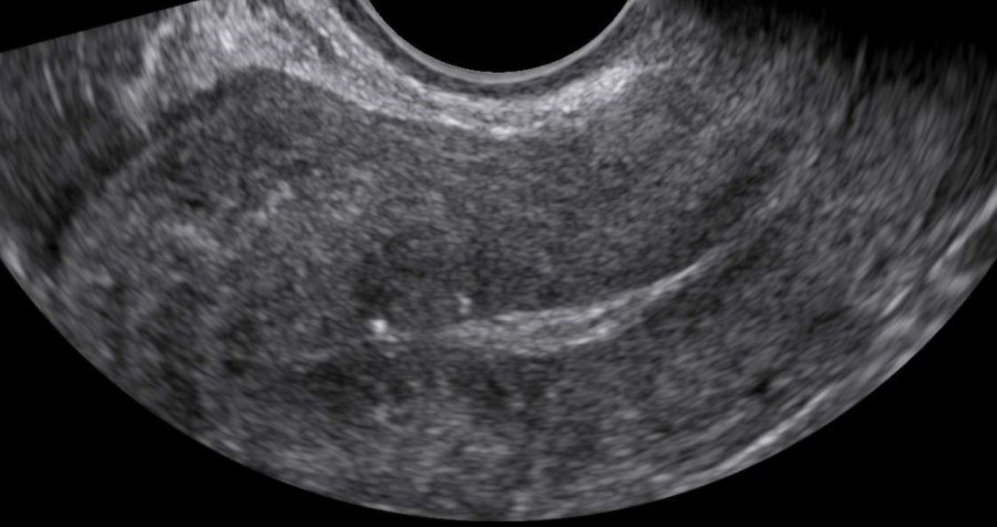 Adenomyosis