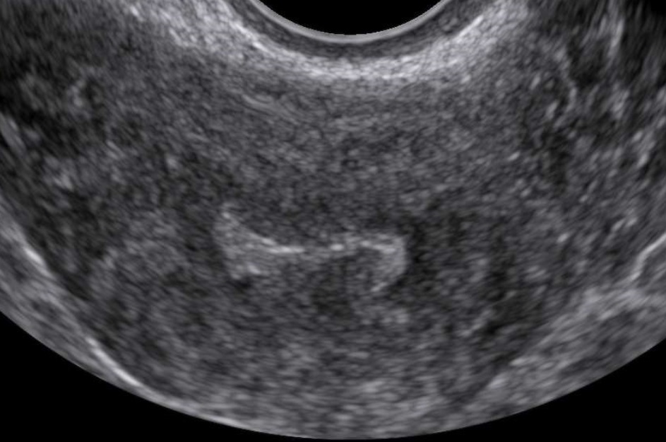 echogenic endometrial buds in adenomyosis