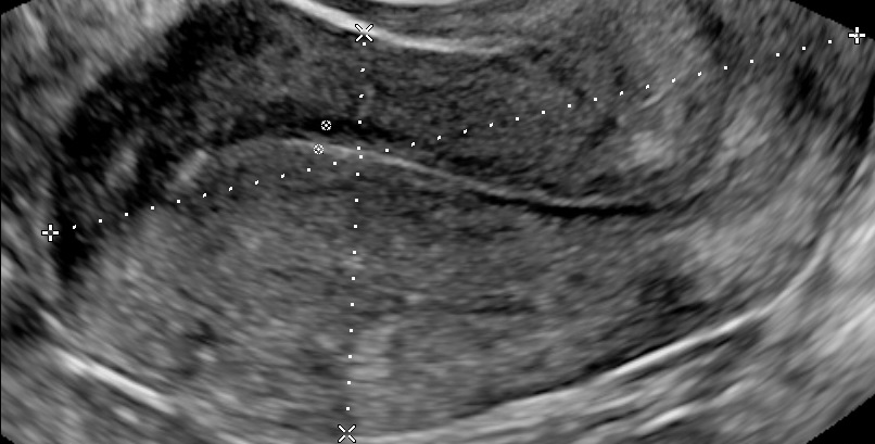 asymmetrical thickening of myometrium in adenomyosis