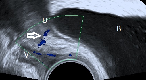 ureterovaginal fistula in ultrasound doppler