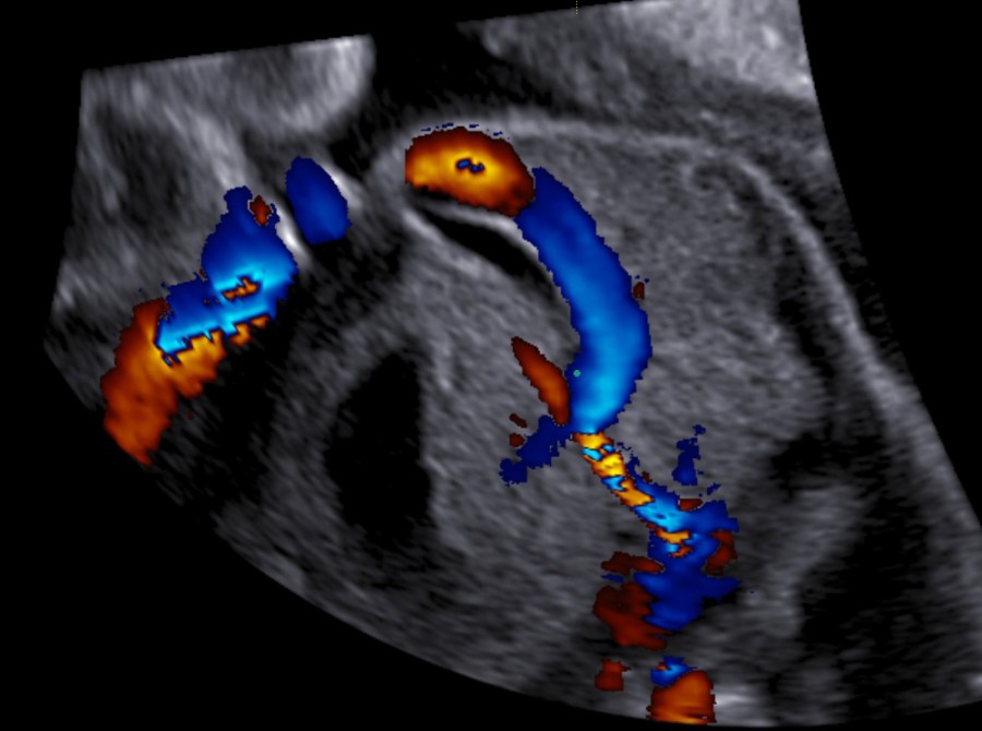 Persistent Right Umbilical Vein