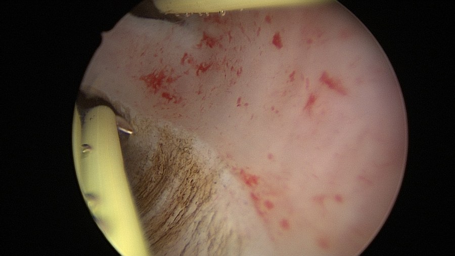 Transcervical Resection of the Endometrium