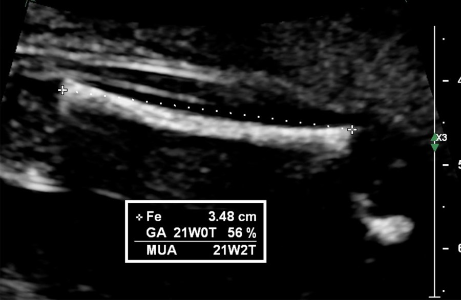 femur length ultrasound