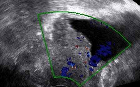 Ultrasound Study of Cervical Cancer
