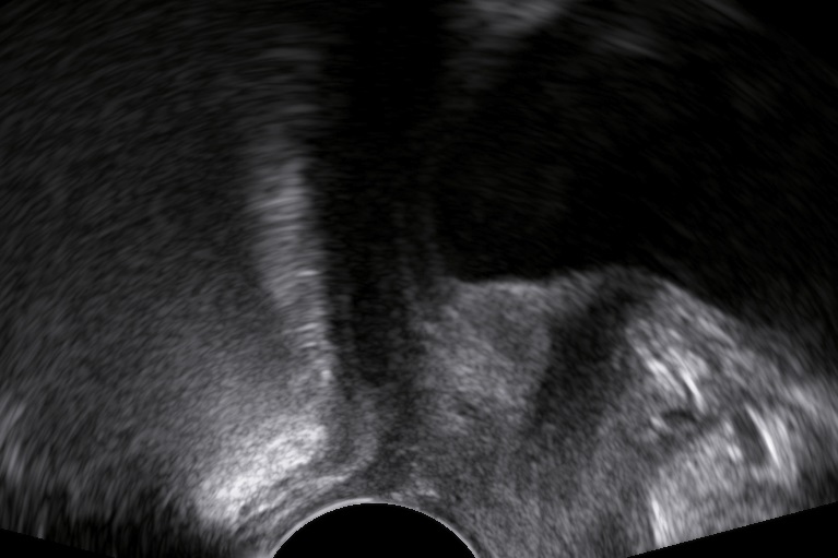 Pelvic Floor Ultrasound: The Rectocele