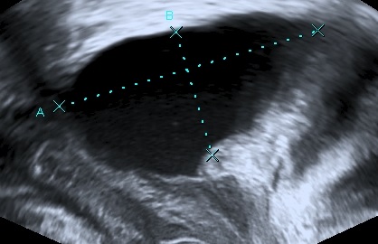 ultrasound measurement of postvoid residual bladder volume