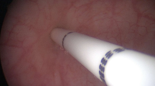 Bladder Injection with Botulinum Toxin A