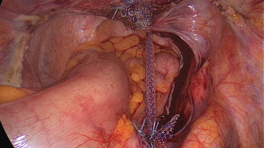 Laparoscopic Sacrocervicopexy