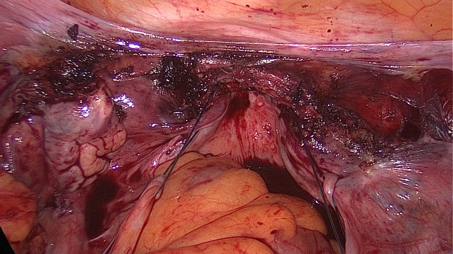 Laparoscopic Uterosacral Ligament Suspension