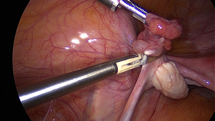 Laparoscopic Bilateral Salpingectomy: Tips & Tricks