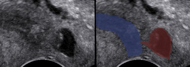 urethra diverticulum