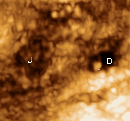 urethra diverticulum 3d with stone