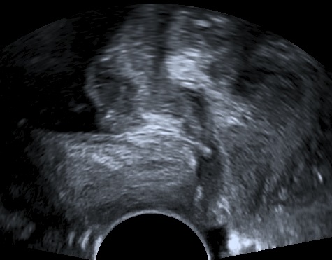 How to: Ultrasound in Stress Urinary Incontinence