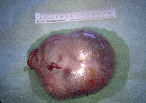 Laparoscopic Management of an Immature Teratoma